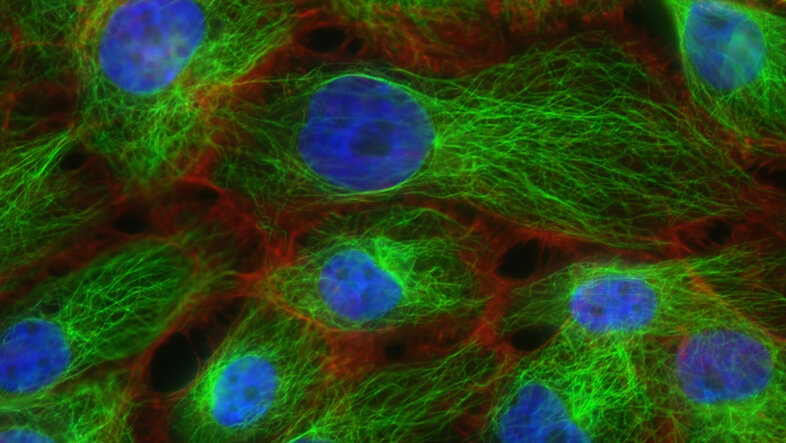 A fluorescent microscope image of cancer cells