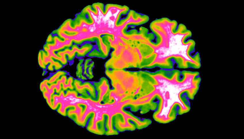 © Picture of an fMRI of a brain. This is an example of how activity of specific brain networks can be visualized using fMRI  